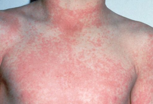 A strep infection causes scarlet fever, which may appear after the throat infection.