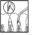 Insert PerioChip, curved end first, into the
periodontal pocket - Illustration