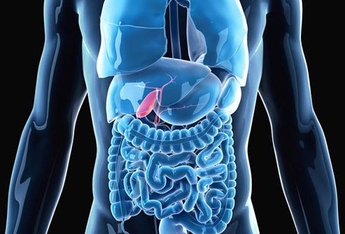 Cholelithiasis occurs when gallstones develop.  If these gallstones block the bile duct, bile can build up in the gallbladder causing inflammation called cholecystitis.