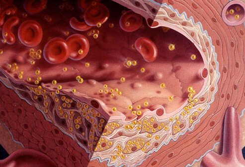 Usually, high cholesterol does not produce any symptoms and you may not know your blood cholesterol is too high.
