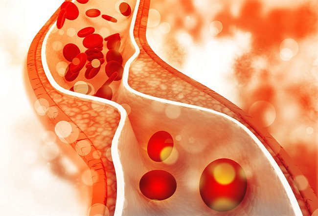 What Are the Symptoms of Critical Limb Ischemia