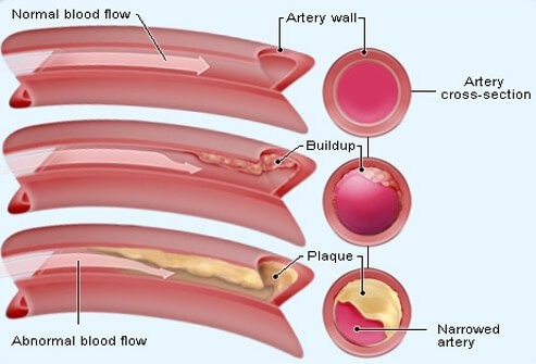 Cholesterol is a waxy, fat-like substance that your body needs to function normally.