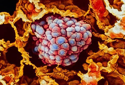 As mentioned previously, smoking, the leading cause of lung cancer, is also a major cause of COPD.