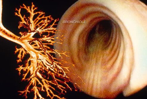 Many patients with COPD also develop chronic bronchitis.