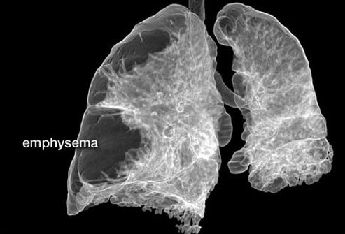 Emphysema is a disease of the lung.