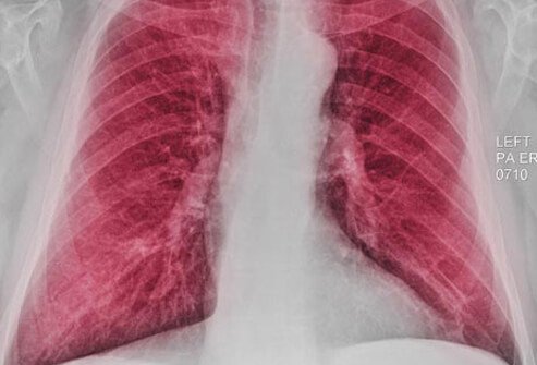 A chest X-ray may be able to show enlarged lungs that can occur in some patients with COPD (due to hyperinflation).