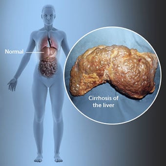 3D illustration showing the location of the human liver and a callout of cirrhosis of the liver.