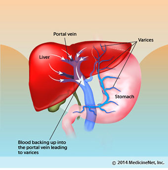 Illustration shows blood backing up into the portal vein which can cause bleeding from the esophageal varices.