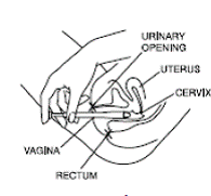 Hold the applicator as shown - Illustration