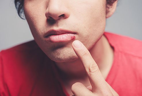 Cold sores and canker sores are not the same thing although they share some similarities.