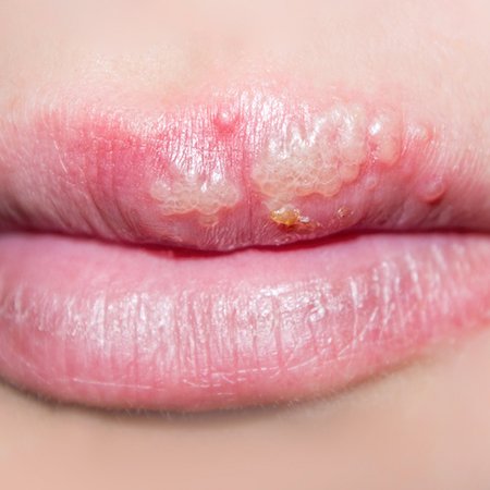 Picture of cold sores