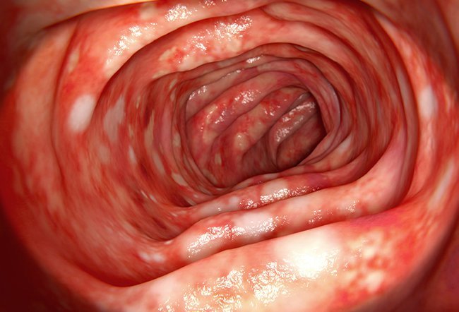 Ulcerative colitis is a type of inflammatory bowel disease. While there's no known ulcerative colitis cure, treatment can help you manage your symptoms and let you lead a full life.