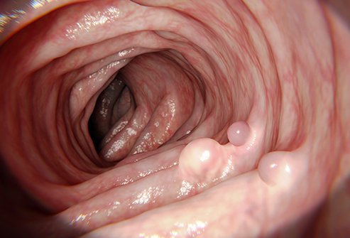 Picture of colon polyps.