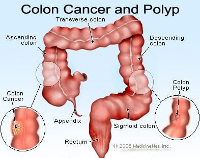 Picture of colon polpys and colon cancer (colorectal).
