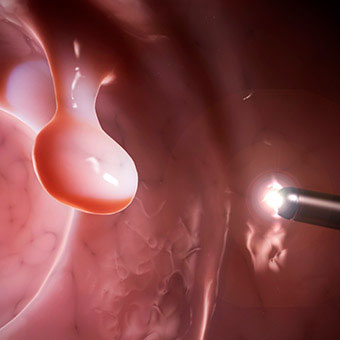 An illustration shows a colonoscope light on a polyp.