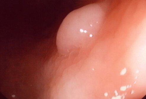 Polyp