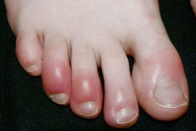 Skin rash symptoms such as Covid toe have become associated with Covid-19