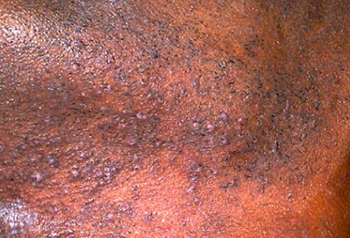 This eruption occurs in areas of the skin in which hairs have been recently cut or extracted.