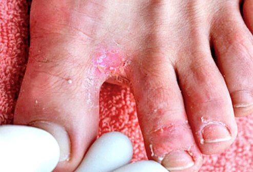 One of the most commonplace skin conditions is athlete's foot.