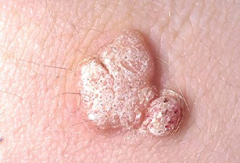 The development of small keratotic tumors of the skin is caused by one of about 200 members of the human papillomavirus group.