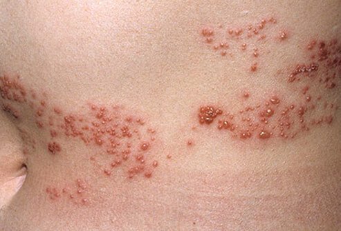 Shingles, also known as herpes zoster, is a skin disease caused by the return of a chickenpox infection.