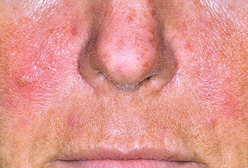 Rosacea is a chronic inflammatory condition of the face that is characterized by redness.