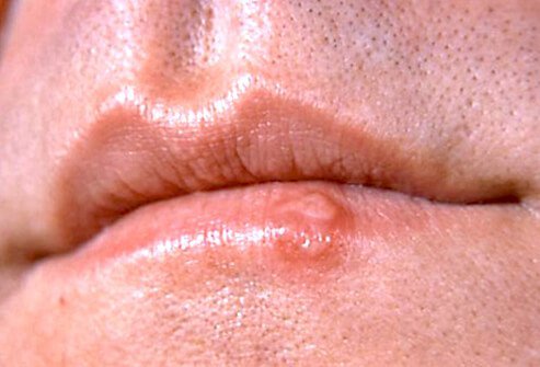 Cold sores commonly appear on the edge of the lip.