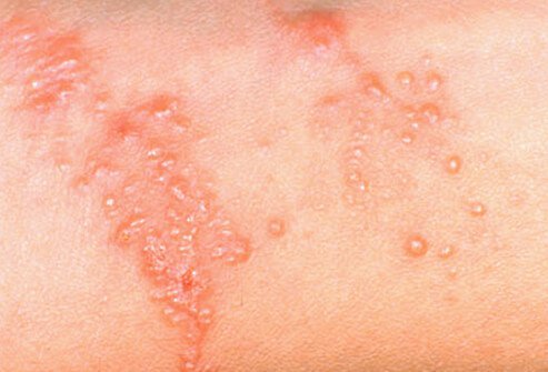 In allergic individuals, the development of a linear blistering eruption occurs within 24-48 hours of exposure to a member of the poison ivy or poison oak family of plants.