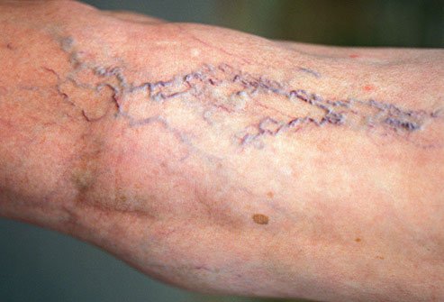 Varicose veins can cause leg pain and other symptoms.