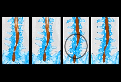 Spinal stenosis is a narrowing of the spaces within the spine.