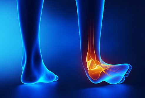 A sprained ankle causes lower leg pain.