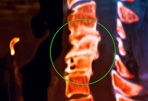 Your vertebrae have slippery tissue on each end that helps your back flex without friction.