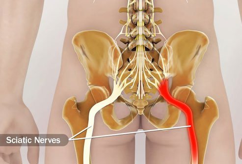 If pain shoots down from your lower back, through your bottom, and into your leg, the culprit may be your sciatic nerve.