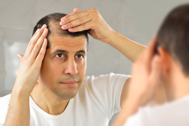 Men are more likely to experience hair loss than women.
