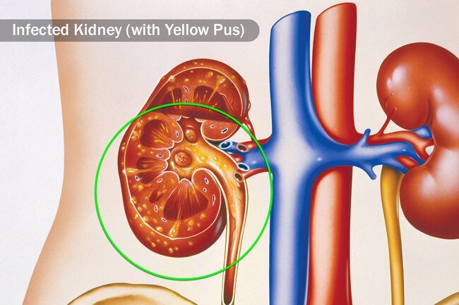 A kidney infection can occur if a UTI gets worse and you may notice blood in the urine.