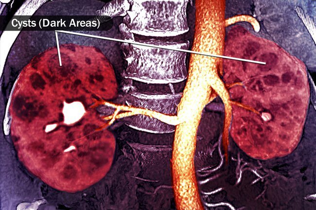 Blood in the urine is one possible symptom of polycystic kidney disease (PKD).