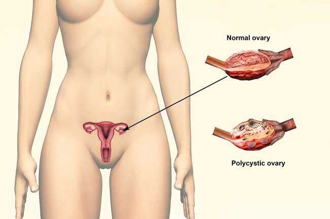 You may lose hair when you have polycystic ovary syndrome (PCOS).