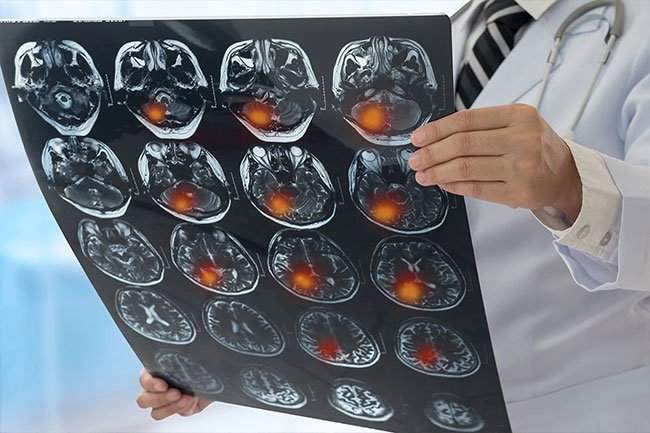 Brain tumors may be accompanied by hallucinations. 