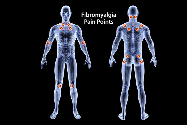 Doctors may assume you have anxiety when you really have fibromyalgia.