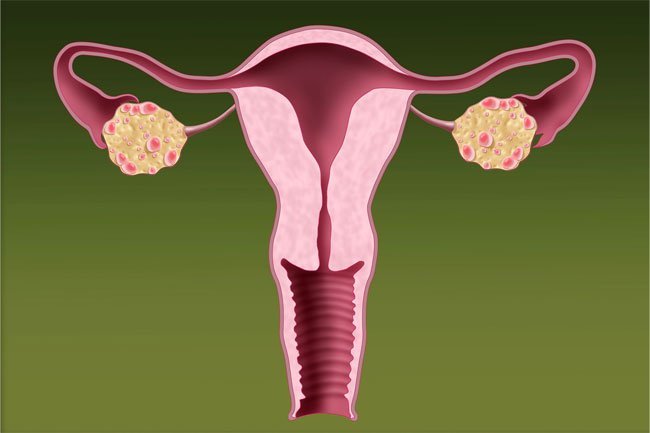 PCOS may be accompanied by anxiety symptoms.