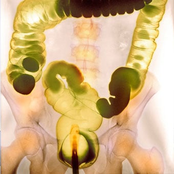 A colored contrast barium enema X-ray.