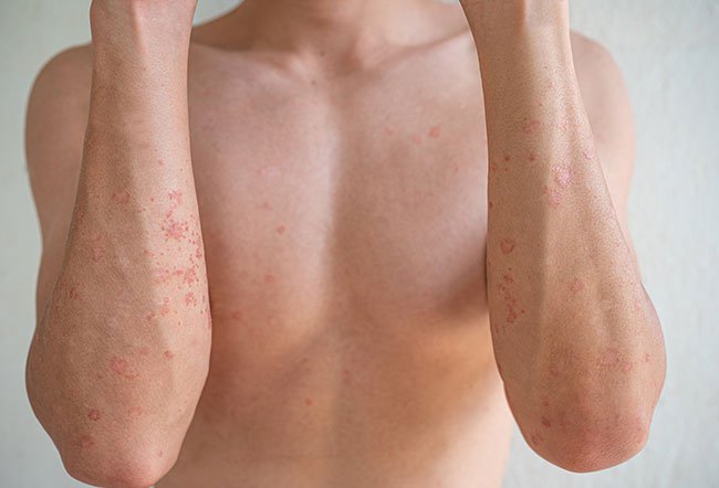 The word dermatitis refers to inflammation (redness and swelling) of the skin.