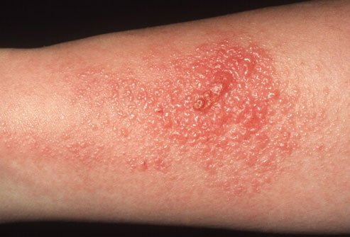 Poison ivy has an oily toxin that often causes a painful allergic skin reaction, as do poison oak and sumac.
