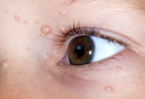 It causes mild, small growths, often with dimpled centers.