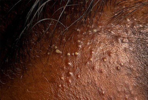 Folliculitis is infection of the follicles.