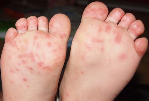 Hand-foot-and-mouth disease is a viral disease that causes red spots on the palms and soles.