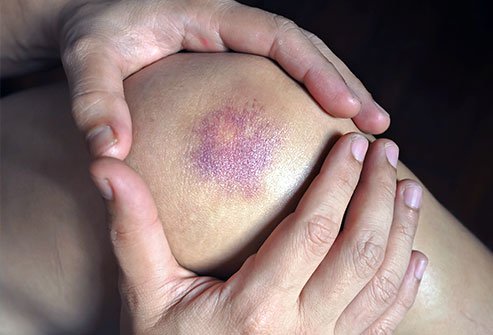 A contusion is a bruise. You treat a contusion injury with rest, ice, compression and elevation. Severe contusions are treated with physical therapy, physical assistance and surgery. 