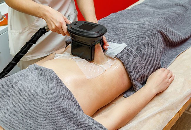 Cool sculpting or cryolipolysis is a nonsurgical or noninvasive method for body contouring.
