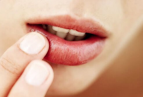 Cold sores, also known as fever blisters, can make you feel uncomfortable and self-conscious.