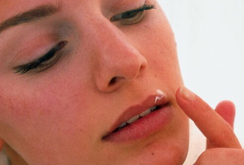 Antiviral creams may reduce healing time, but these must be applied at the very first sign of an outbreak.